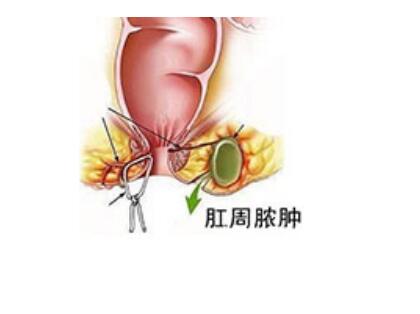 肛周膿腫最新手術方法及其應用研究